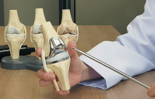 Total Knee Replacement