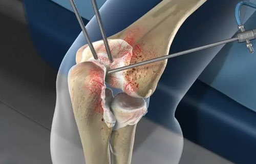 Arthroscopy Surgery